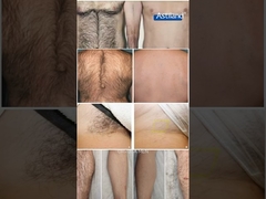 لیزر موهای قبل و بعد