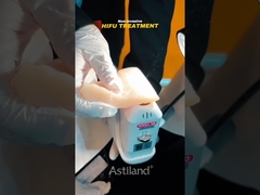 شاهد قدرت بلند کردن غیر تهاجمی HIFU باشید