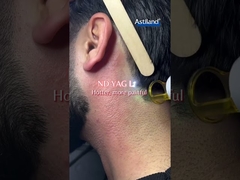 ليزر ديود در مقابل ليزر ND YAG، کدوم رو ترجيح ميدي؟