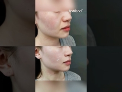 آیا RF+ HIFU را برای سفت کردن پوست امتحان کرده‌اید؟ #ضد_پیری #لیفت_پوست #کلینیک_زیبایی #درمان_صورت